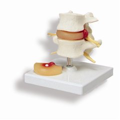 椎間板ヘルニア腰椎モデルA76